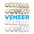 Veneer Vector. Dental Veneer Concept. Medical Banner Design Element. Tooth Before And After. Illustration
