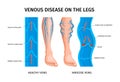 Venous Disease Of Legs Infographics Poster Royalty Free Stock Photo