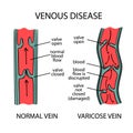 VENOUS DISEASE SCHEME Varicose Veins Of Human Medicine