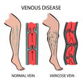 VENOUS DISEASE Varicose Veins Of Human Medicine Education