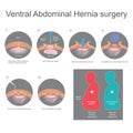 Ventral hernia is a bulge of tissues through an opening of weakness within your abdominal wall muscles. Info graphic vector. Royalty Free Stock Photo