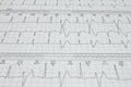 Ventricular extrasystole Bigeminism Cardiac arrhythmia recorded on an electrocardiogram