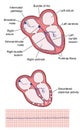 Ventricular fibrillation of heart Royalty Free Stock Photo