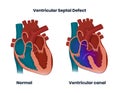 Ventricular septal defect with normal heart anatomy. Illustration of the congenital heart defect