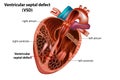 Ventricular septal defect VSD Royalty Free Stock Photo