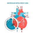 Ventricular septal defect VSD with heart blood flow. Human heart muscle diseases cross-section.