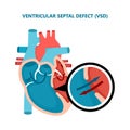 Ventricular septal defect VSD. Human heart muscle diseases cross-section. Cardiology concept. Royalty Free Stock Photo