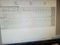 Ventricular Tachycardia Caught on Hospital Rhythm Strip