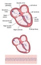 Ventricular tachycardia of heart