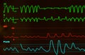 Ventricular Tachycardia on Monitor