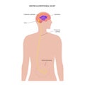 ventriculoperitoneal shunt concept