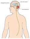 Ventriculoperitoneal shunt