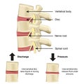 Vertebral body and disc anatomy and functionality on pressure medical vector illustration Royalty Free Stock Photo