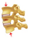 Vertebral compression fracture Royalty Free Stock Photo