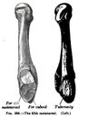 Vertical anatomy drawing and text of the fifth metatarsal, from the 19th century