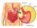 Vertical banded gastroplasty