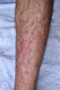 Vertical closeup of post-vaccination rashes on the skin