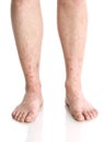 Vertical closeup shot of male feet with red rashes Royalty Free Stock Photo