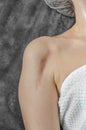 Vertical keloid scar after bone surgery on a womanÃ¢â¬â¢s shoulder