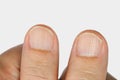 Vertical ridges on the fingernails Royalty Free Stock Photo