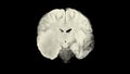 Vertical section through cerebral hemispheres