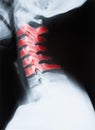 Vertical shot of an X-ray image of the neck and cervical spine Royalty Free Stock Photo