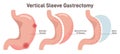 Vertical sleeve gastrectomy. Distended stomach surgery, gastroenterology