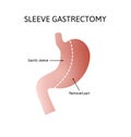 Vertical Sleeve Gastrectomy. Human stomach anatomy isolated on white background. decrease in stomach volume. vector