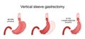 Vertical Sleeve Gastrectomy. Stomach before and after a surgical weight-loss procedure