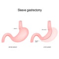 Vertical sleeve gastrectomy