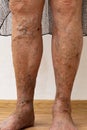 Senior woman bare legs with protruding varix, spider varicose veins medical condition. Skin dermatology and health care