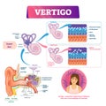 Vertigo vector illustration. Labeled medical vestibular ear problem scheme. Royalty Free Stock Photo