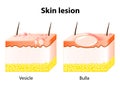 Vesicle and Bulla. Skin lesion Royalty Free Stock Photo