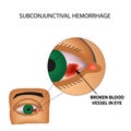 The vessel in the eye burst. Inflammation and redness. The structure of the eye. Infographics. Vector illustration