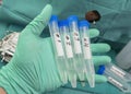 Vials with four samples of cerebrospinal fluid in patients with transverse myelitis after being injected with an experimental