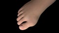 Hallux valgus deformity overview