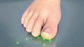 Onychomycosis of the toenail overview