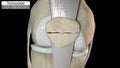 Transverse non displaced patella fracture overview