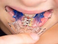 View of child jaw with braces installed to tooth