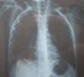 View of a child x-ray film, taken to examine the lungs. Pneumonia