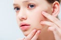 View of displeased teenage girl having acne on face isolated on grey Royalty Free Stock Photo