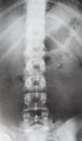 View of human spine in torso on X-ray image