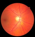 View inside human eye disorders showing retina, optic nerve and macula. Retinal picture ,Medical photo tractional eye