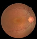 View inside human eye showing retina, optic nerve and macula. Health concept