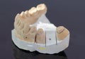 View of plaster model of crowns of lower teeth with implant spacing