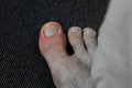 View of a toe with an inflamed nail bed panaritium/ paronychia