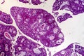 Villous colon adenocarcinoma, light micrograph Royalty Free Stock Photo