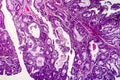 Villous colon adenocarcinoma, light micrograph Royalty Free Stock Photo