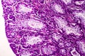 Villous colon adenocarcinoma, light micrograph Royalty Free Stock Photo