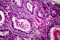 Villous colon adenocarcinoma, light micrograph Royalty Free Stock Photo